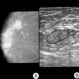 Выделение из сосков что это значит. Выделение из сосков что это значит. Внутрипротоковая папиллома молочной железы дуктография. Выделение из сосков что это значит. Желто гнойные выделения.